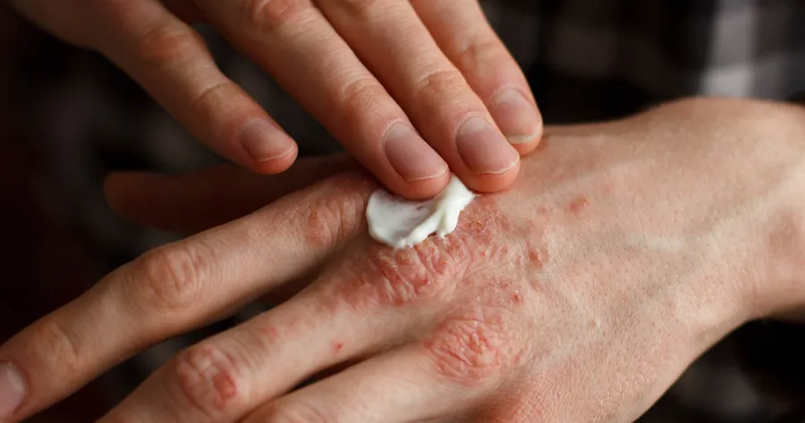 Topical Treatment of Psoriasis