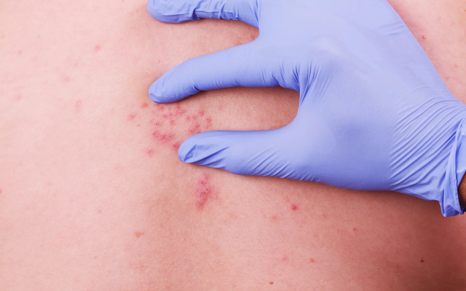 10 Symptoms of Shingles