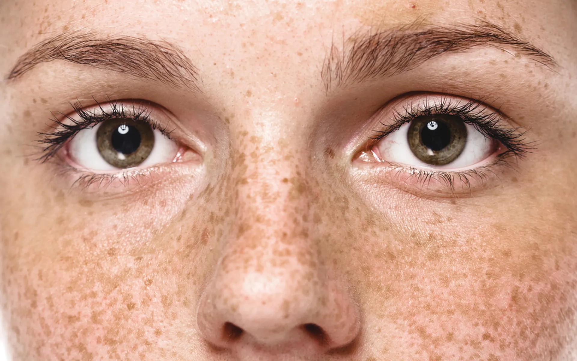 Why Do People Have Freckles?