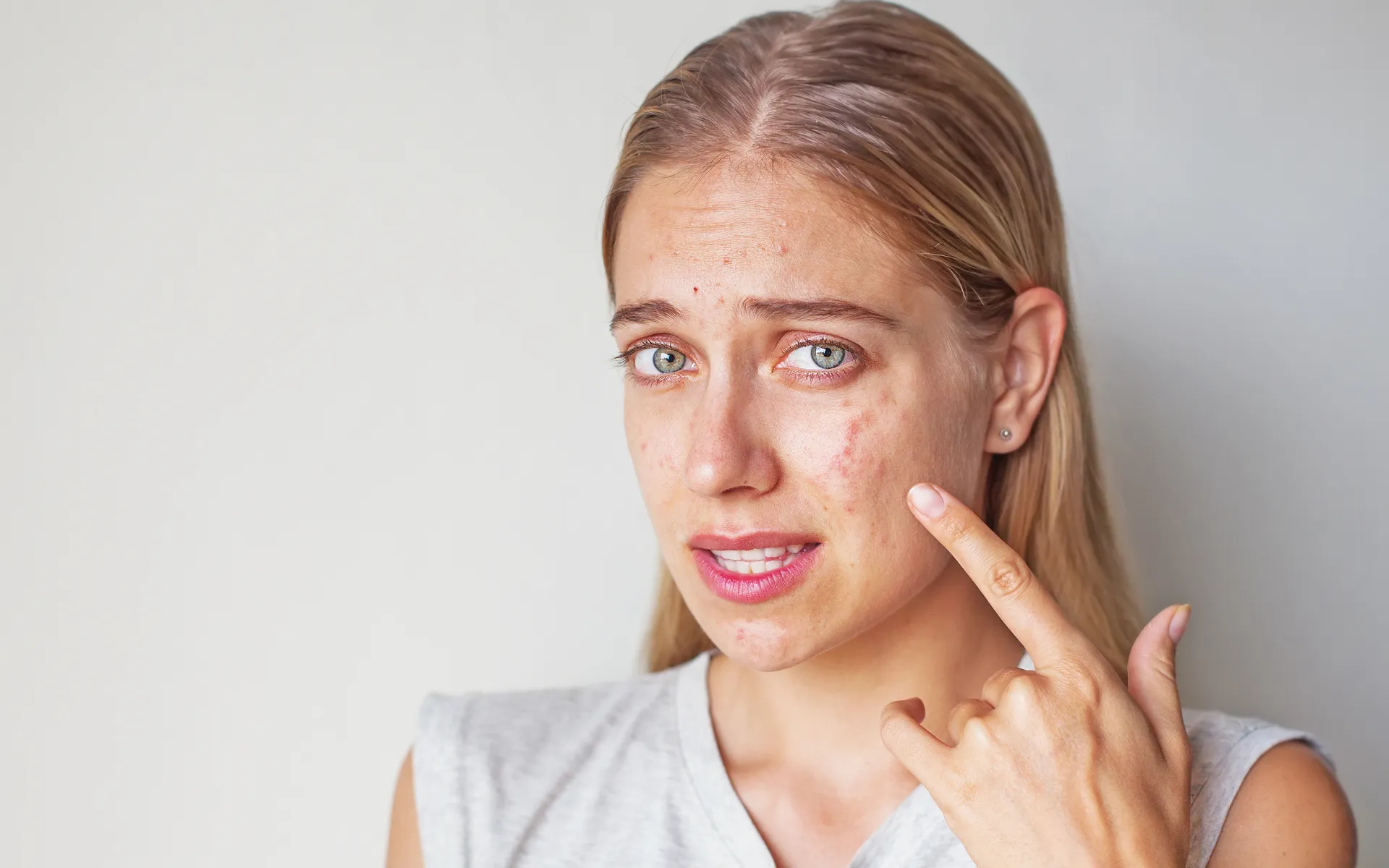 20 Myths About Adult Acne and How to Fight It