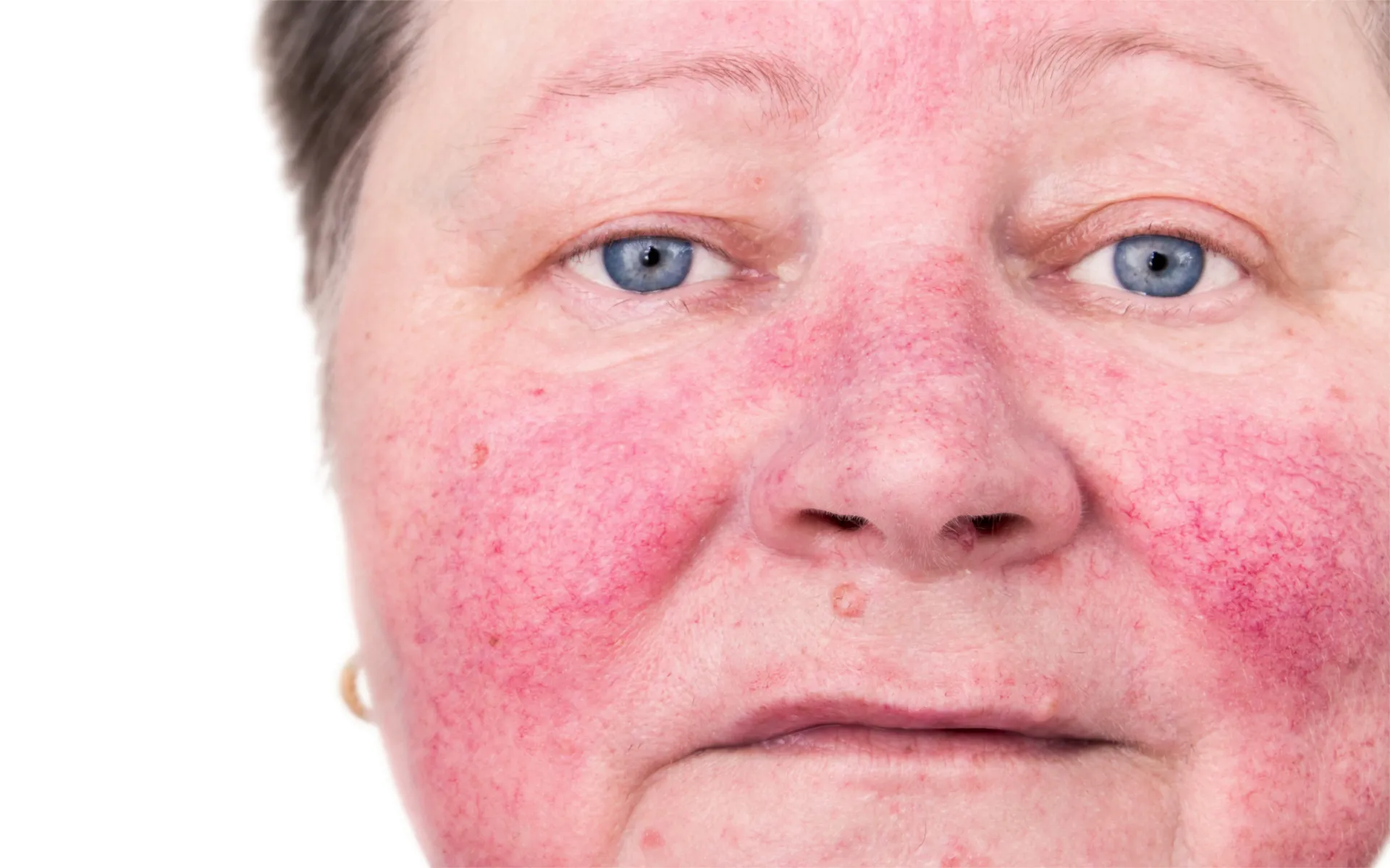 DIY Natural Remedies for Rosacea