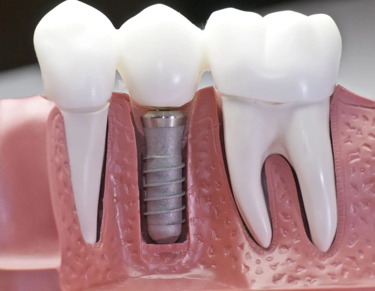 A Concise Guide to Dental Implants