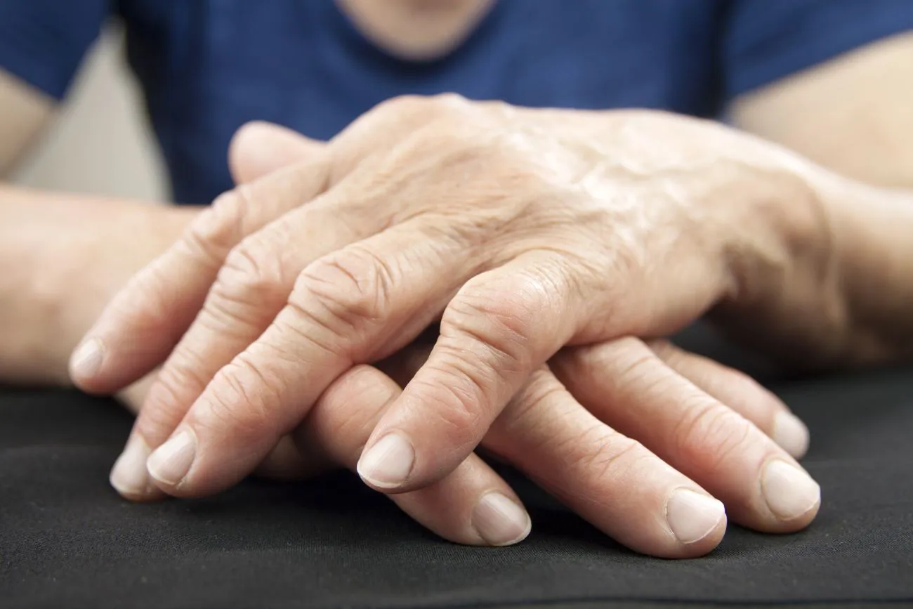 A Concise Guide to Rheumatoid Arthritis