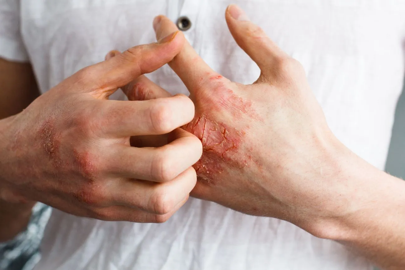 A Concise Guide to Psoriasis