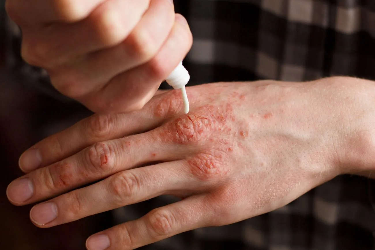 Best Foods to Eat to Fight Psoriasis
