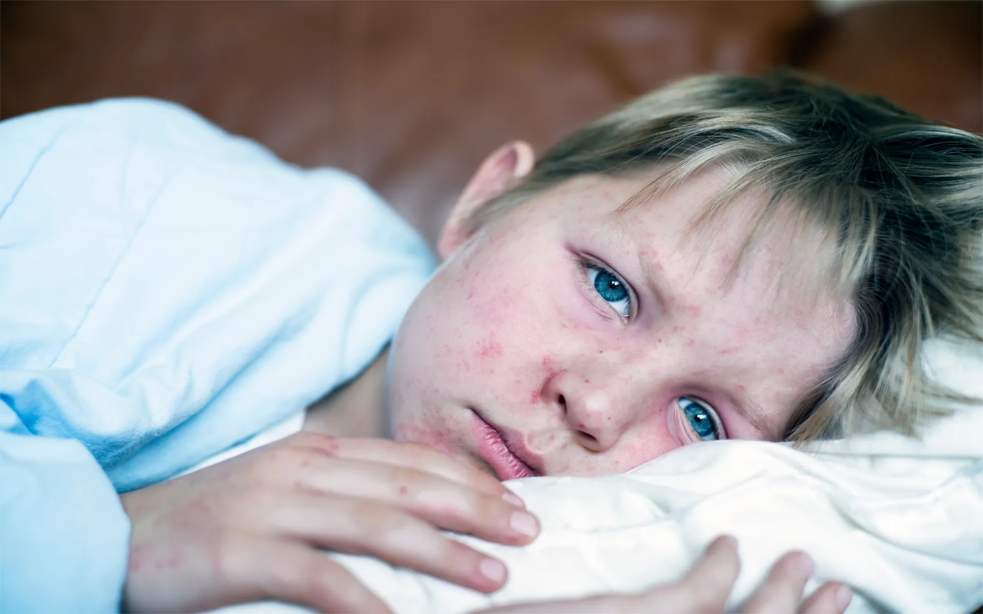 Measles Awareness: What to Do If Your Child’s Been Exposed