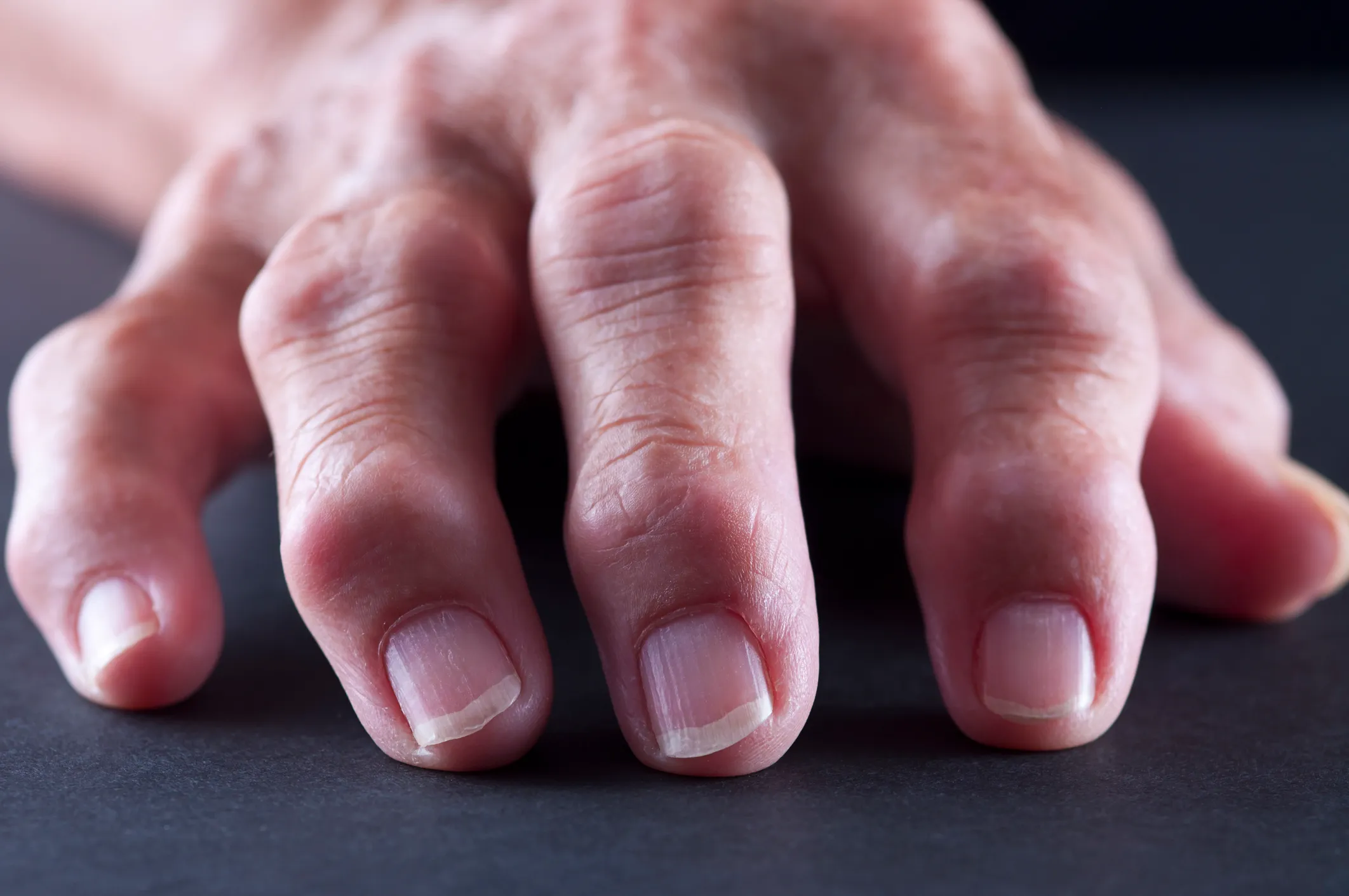 Do You Know the Early Signs of Psoriatic Arthritis?