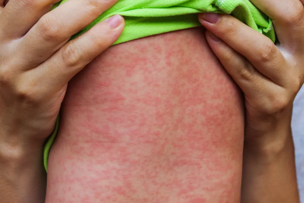 Measles Cases Are Increasing – Are You At Risk?