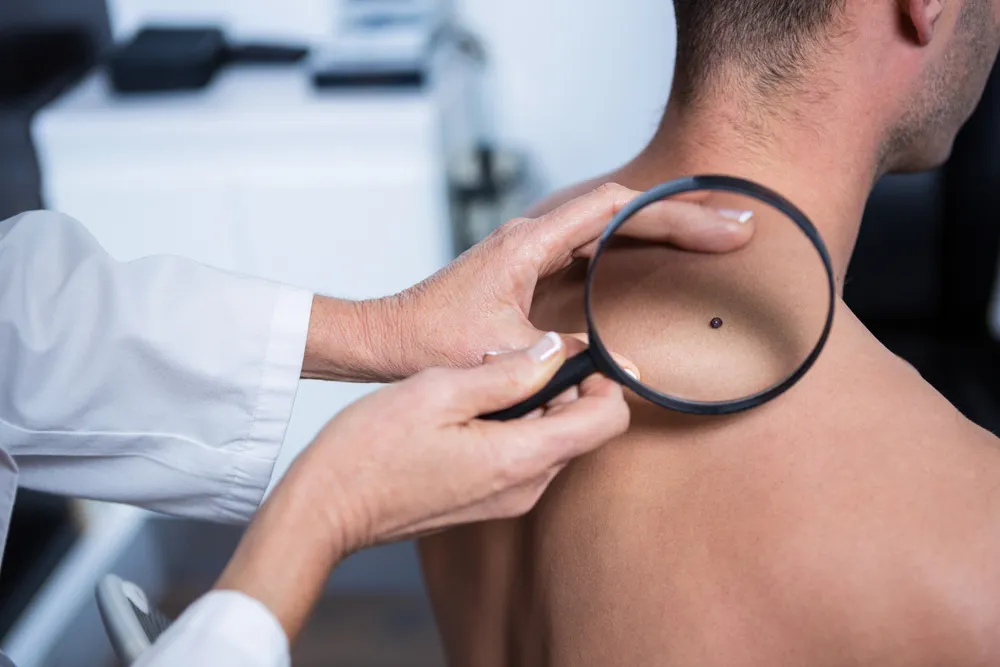 Skin Cancer: Causes, Signs, and Prevention