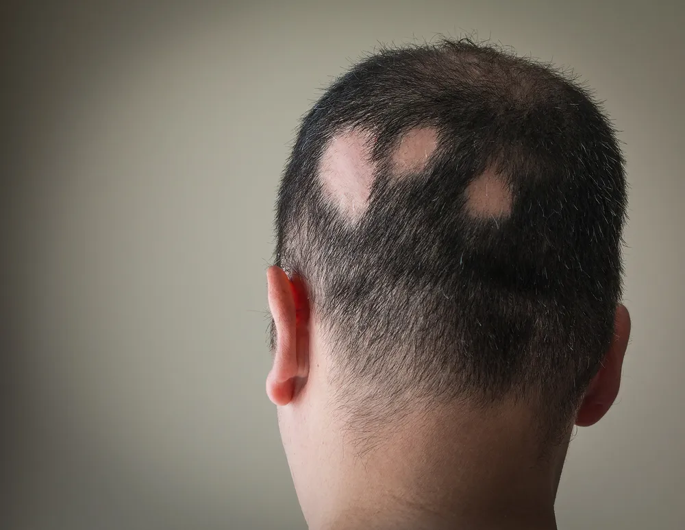 Alopecia: The Causes, Signs, and Treatment Options for a Unique Form of Hair Loss