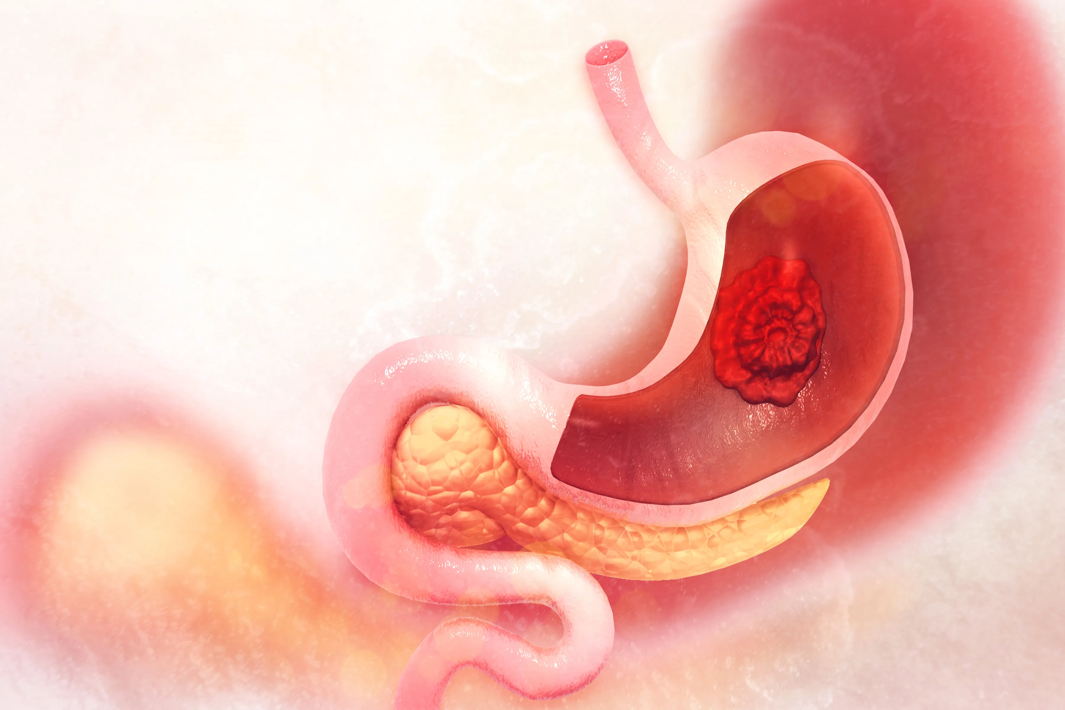 Do You Know the Early Signs of Gastric Cancer?