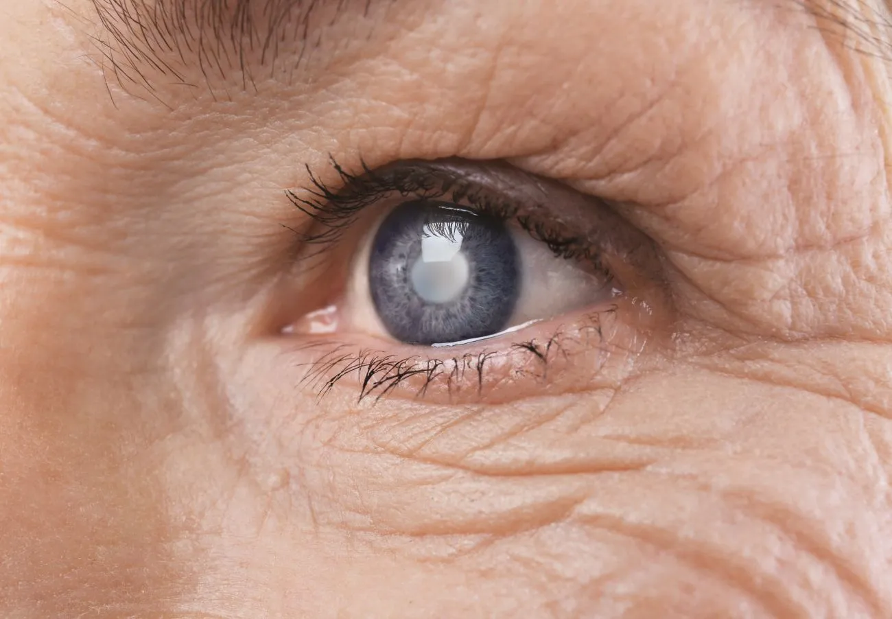 Cataracts Diagnosis and Treatment: When is it Time to Consider Surgery?