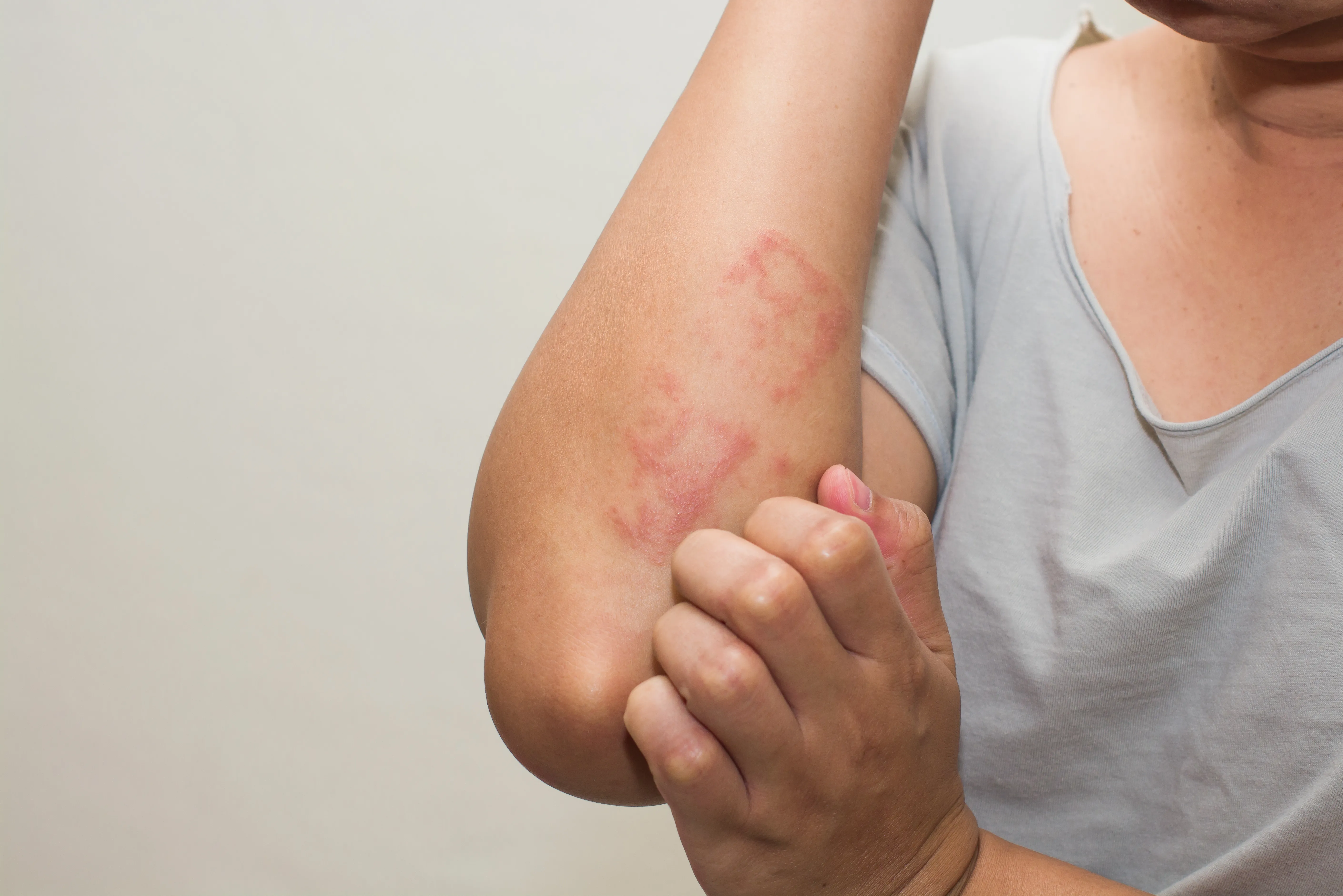 Everything You Need to Know About Eczema