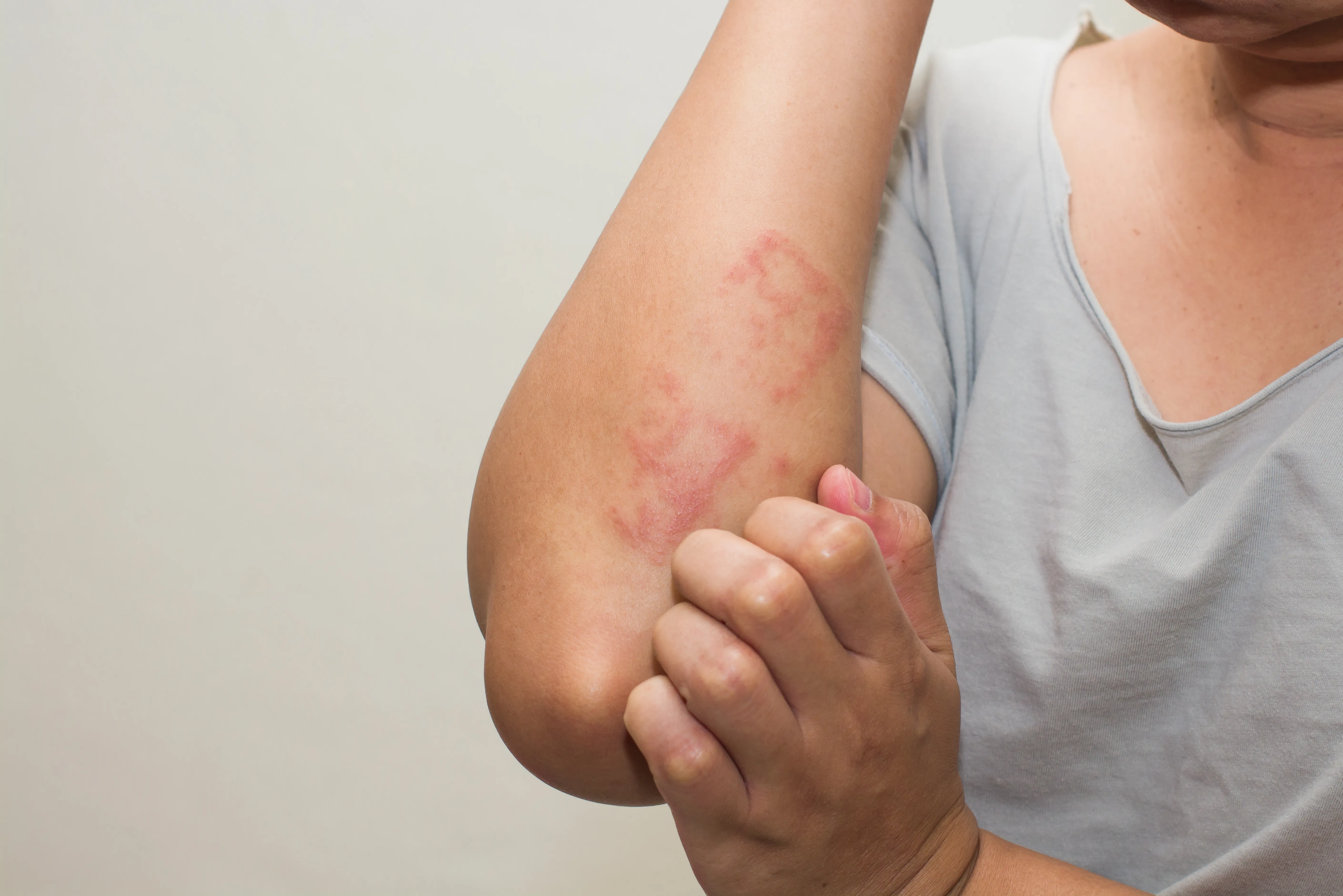 Everything You Need To Know About Eczema Healthversed 1850