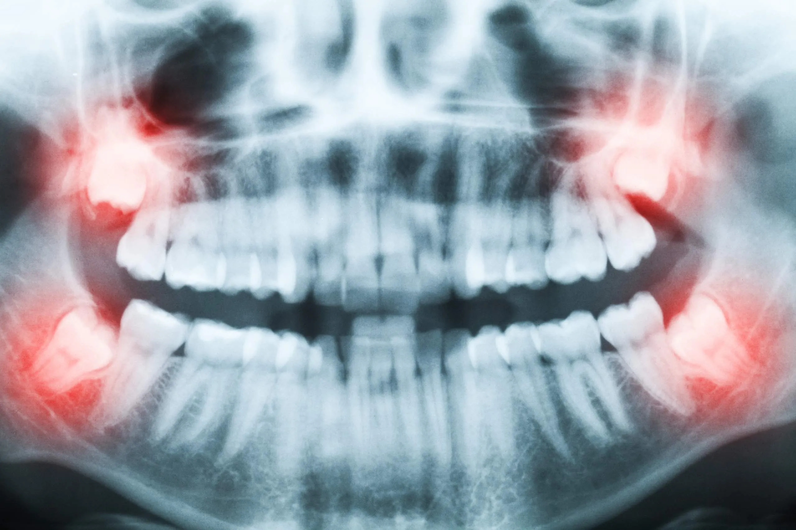 How to Get Wisdom Teeth Removed for Less
