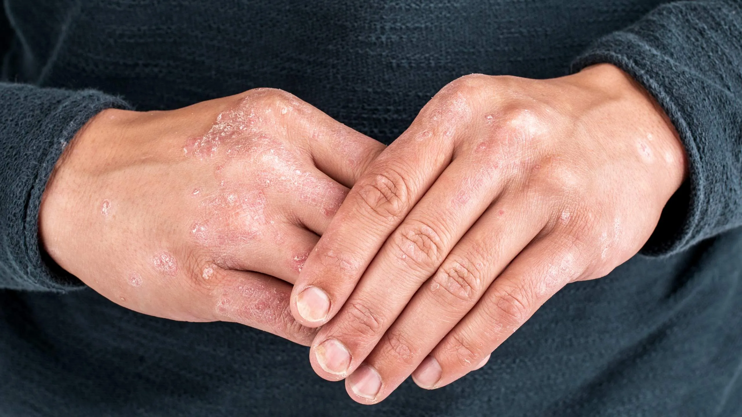 6 Natural Treatment Options for Psoriasis