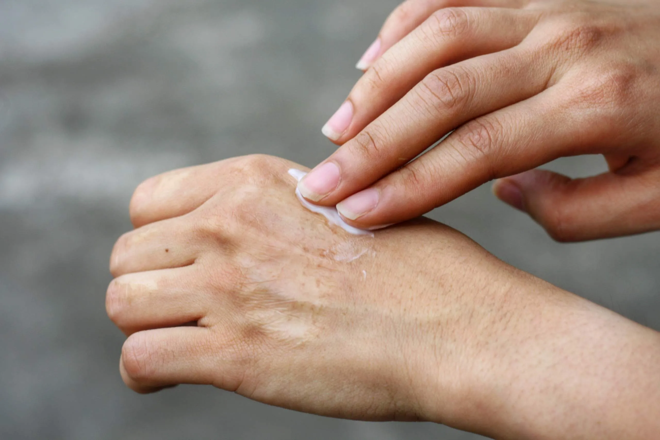 Best Over-The-Counter Eczema Creams