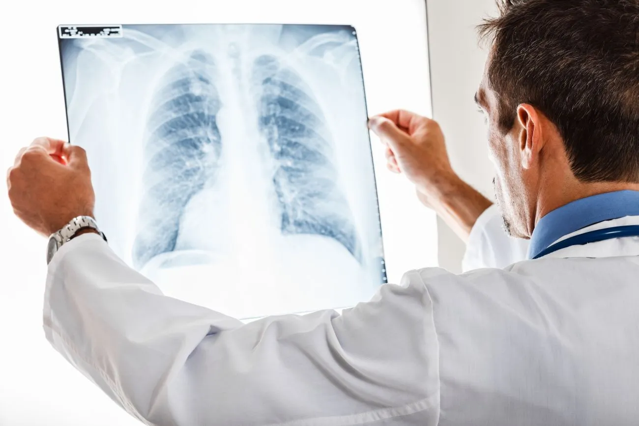 Everything You Should Know About Lung Cancer