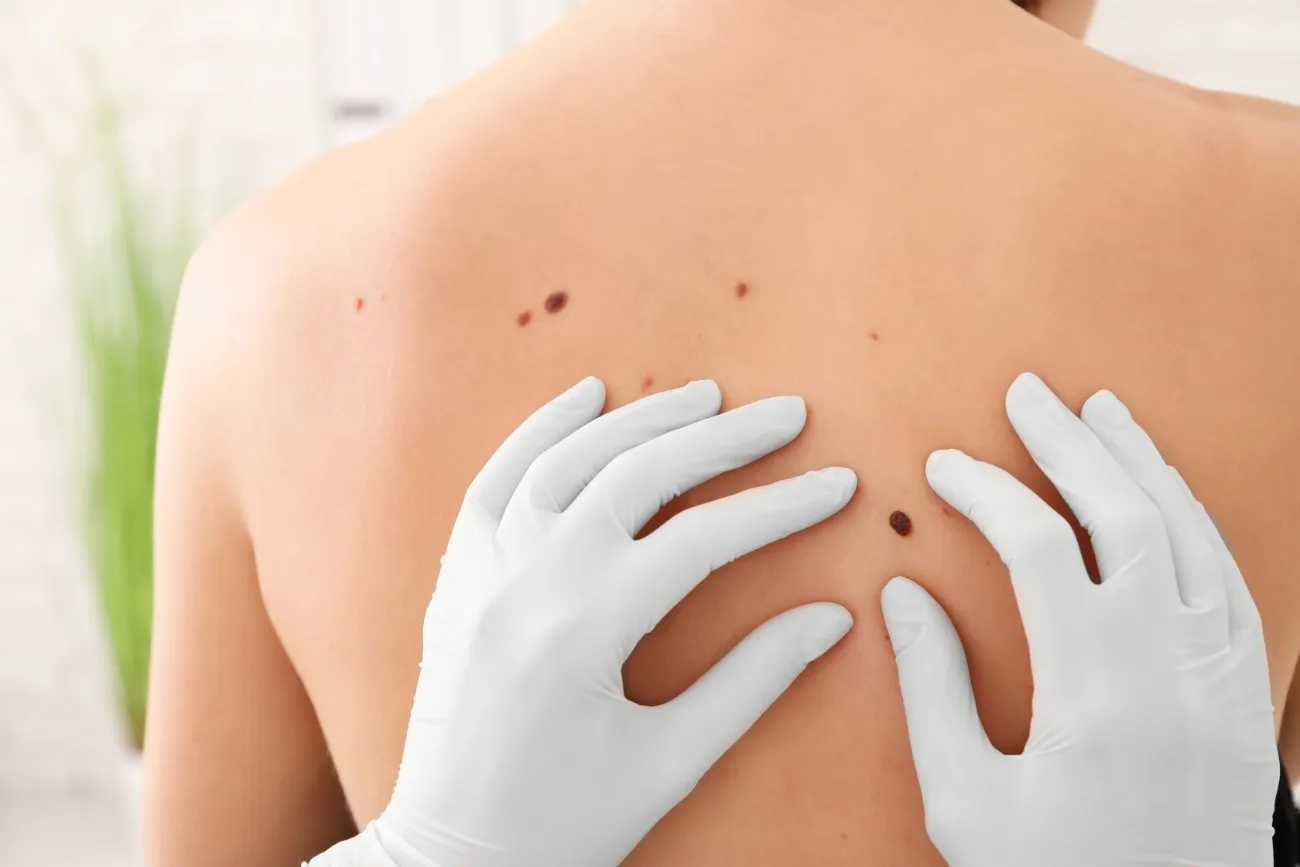 doctor examining mole on woman's back