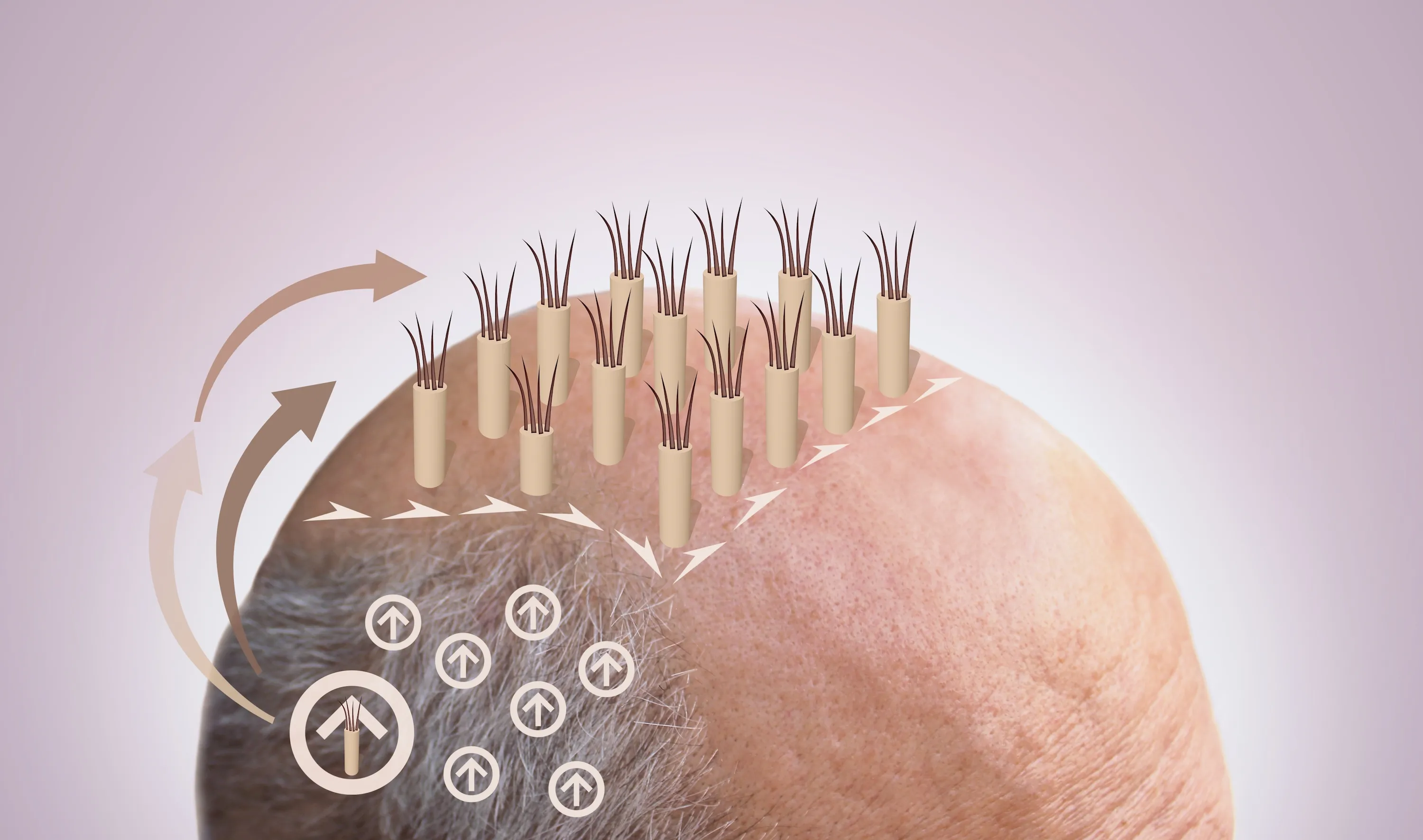 Reasons Why Hair Transplant Surgery is the Best Way to Fight Hair Loss