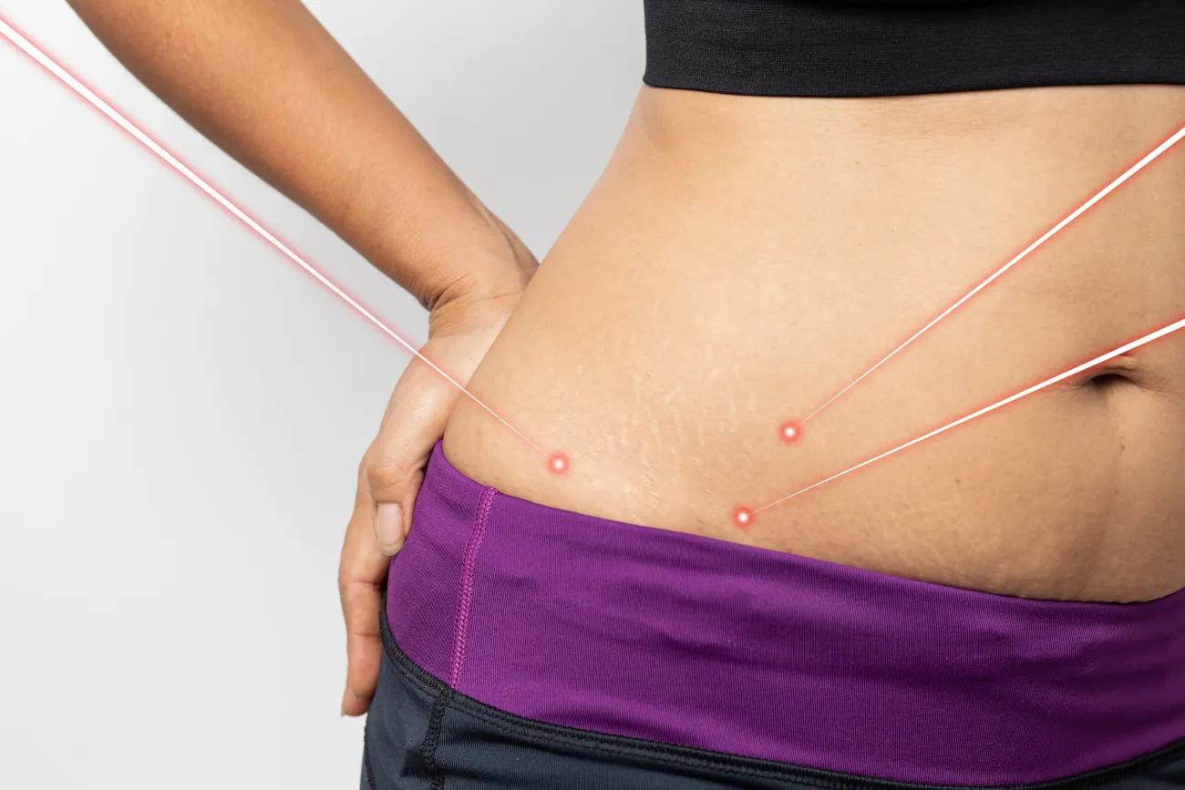 How to Score the Best Bargains on Laser Fat Removal Procedures