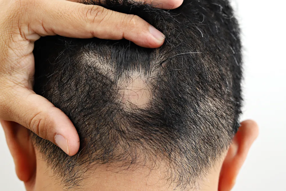 Alopecia: New and Existing Treatments for Alopecia