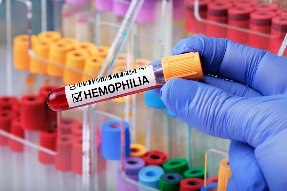 Hemophilia: Exploring the Latest Advancements in Treatment