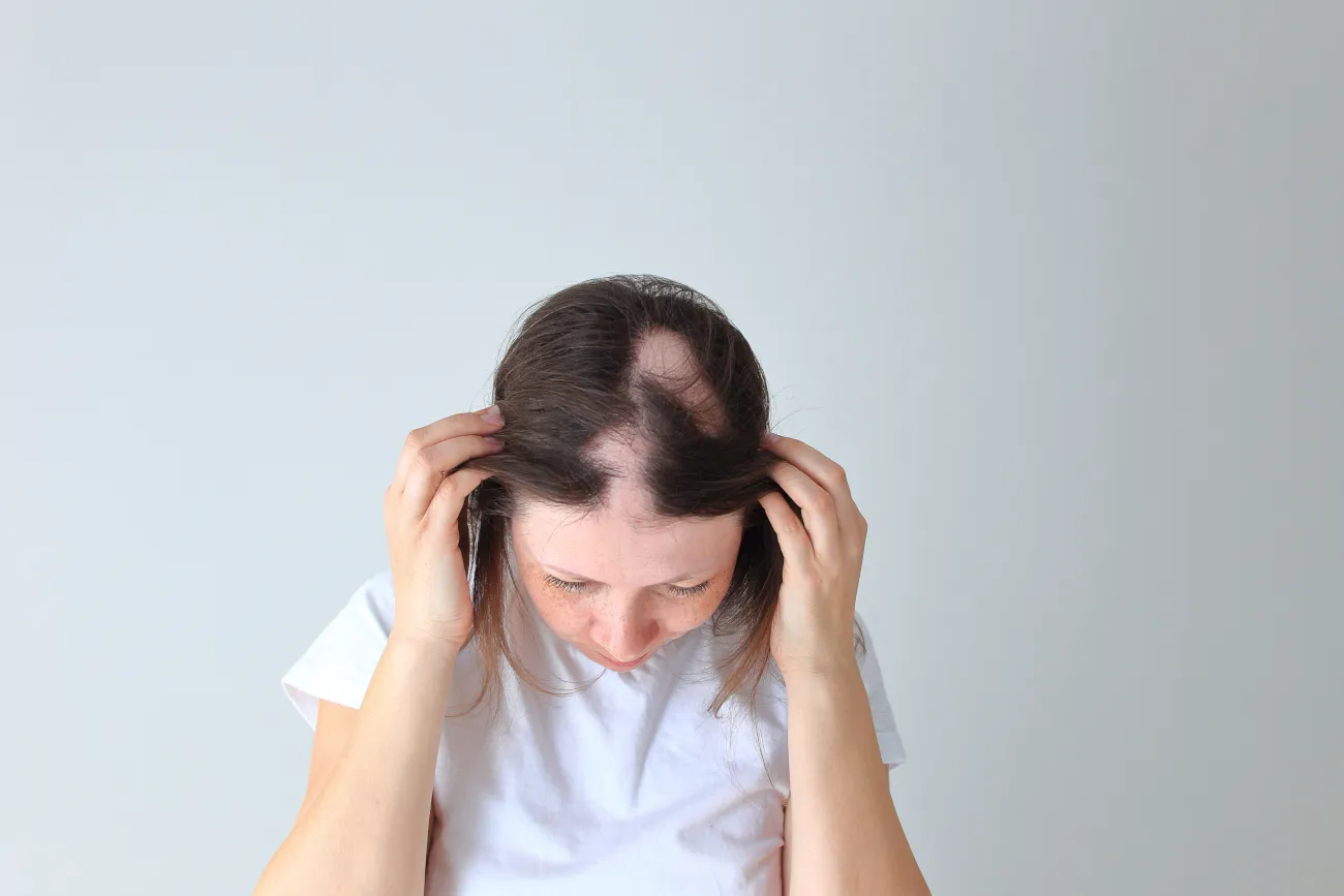Understanding Alopecia: From Warning Signs to Innovative Treatments