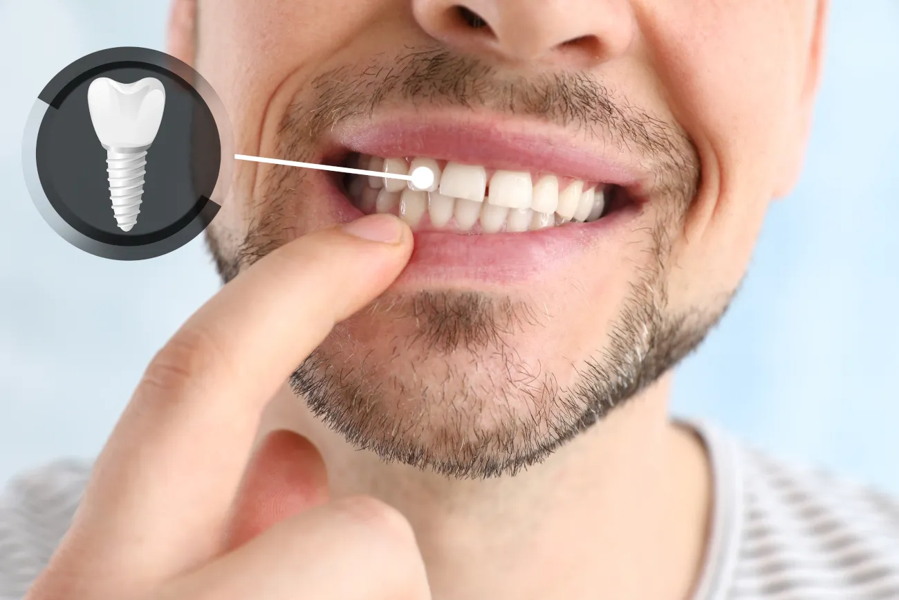 Unlock a New Smile: A Guide to Same Day Tooth Replacement Services in Your Area