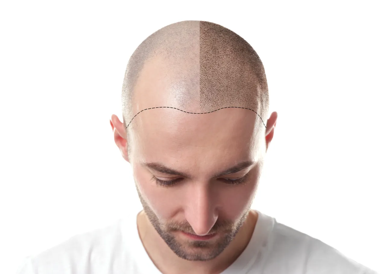 Affordable Hair Transplant Options: Quality vs. Cost Considerations