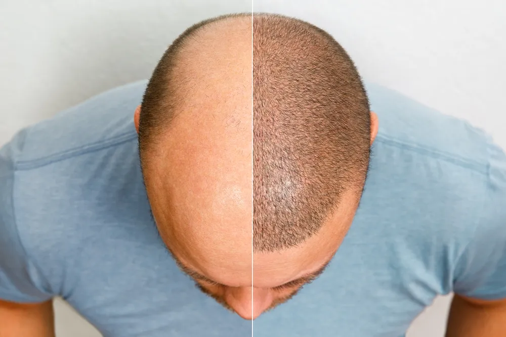A Comprehensive Guide to Low-Cost Hair Transplants