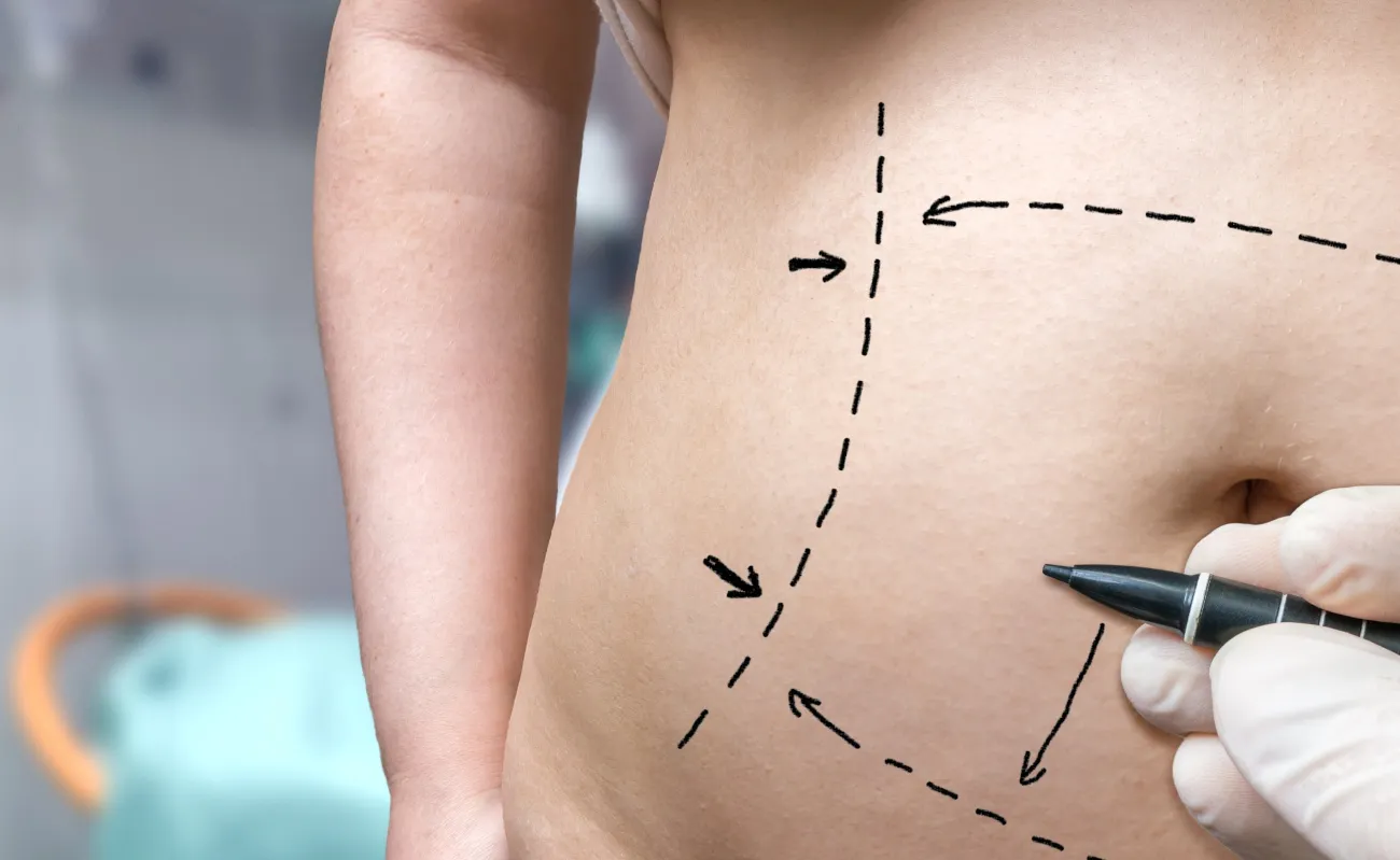 Liposuction Explained: Understanding Different Techniques and Their Benefits