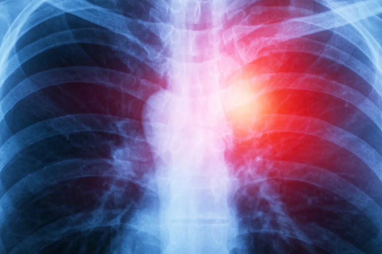Spotting Non-Small Cell Lung Cancer: Symptoms and Signs for Early Awareness