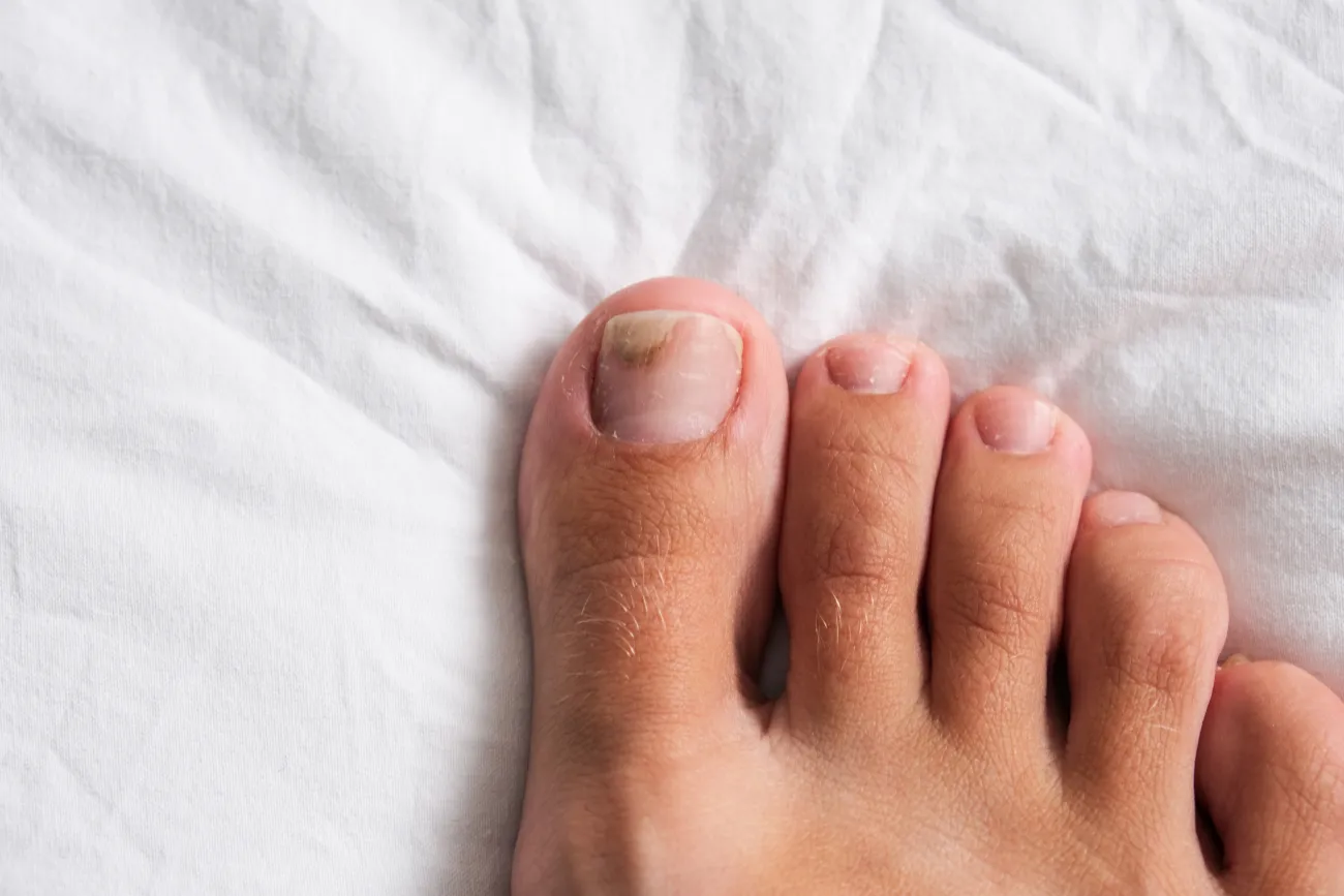 Comparing Nail Fungus Treatments: Which Over-the-Counter Options Really Work?