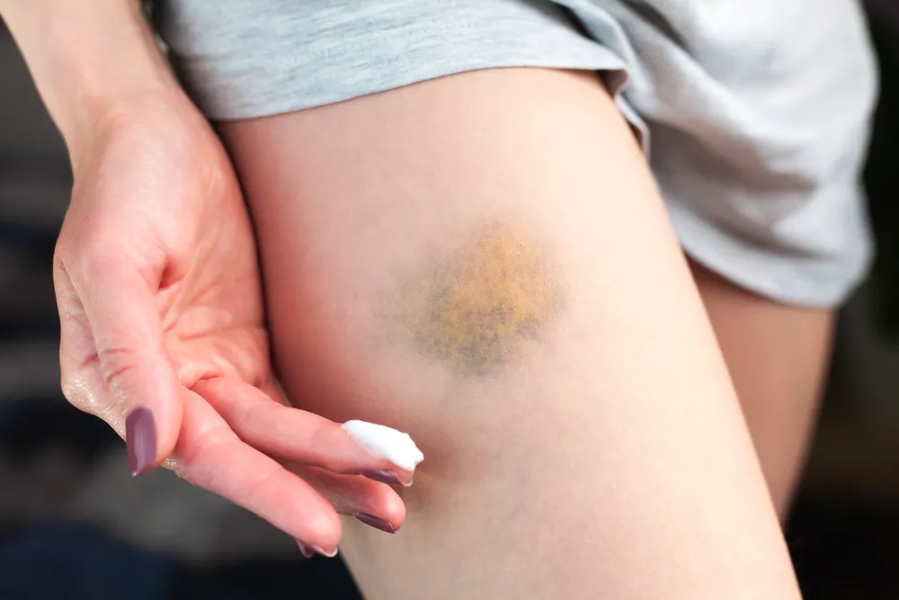 How To Get Rid of Bruises at Home