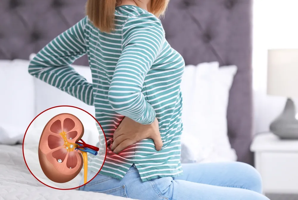 5 Foods That Can Cause Kidney Stones