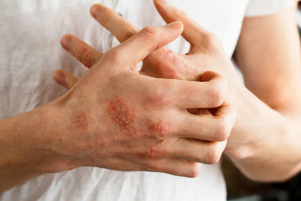 Psoriatic Arthritis: Signs and Symptoms To Know