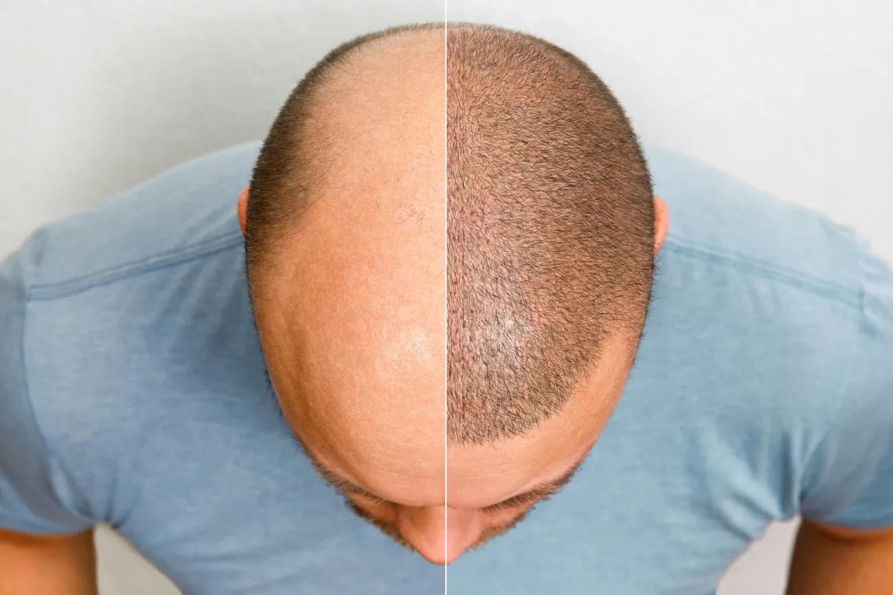 Hair Transplants in Turkey: Top Quality, Unbeatable Value