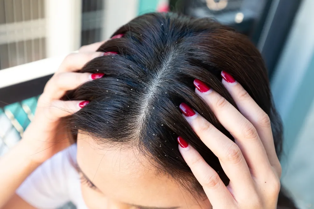 ¿Cómo pueden los tratamientos emergentes mejorar el manejo de la psoriasis del cuero cabelludo?