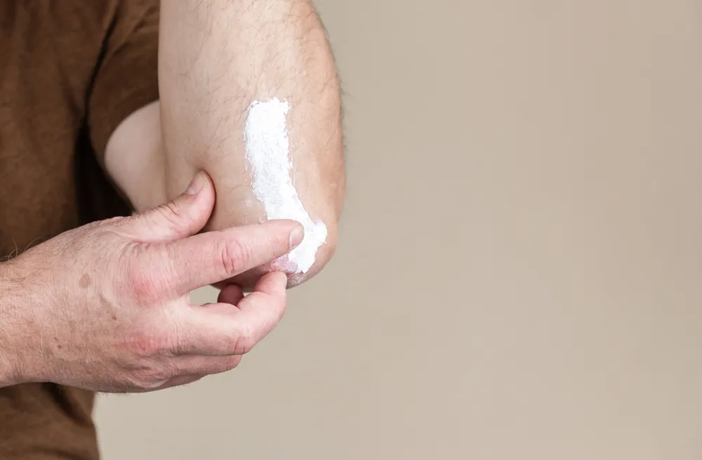 ¿Cuáles Son las Mejores Cremas para Manejar los Síntomas de la Psoriasis?