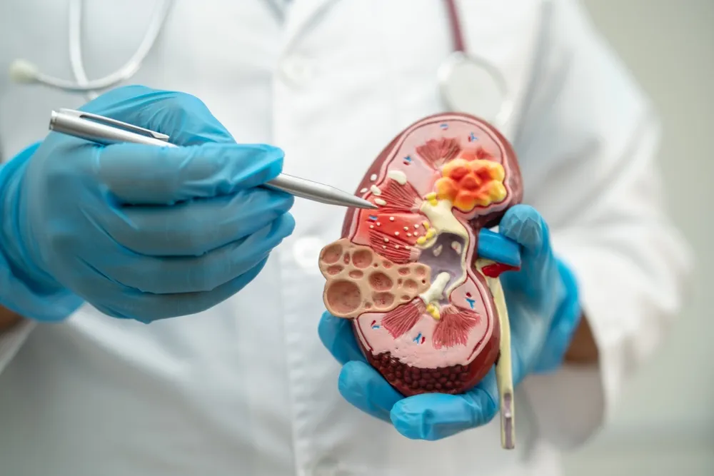 Nueva Esperanza para la Enfermedad Renal