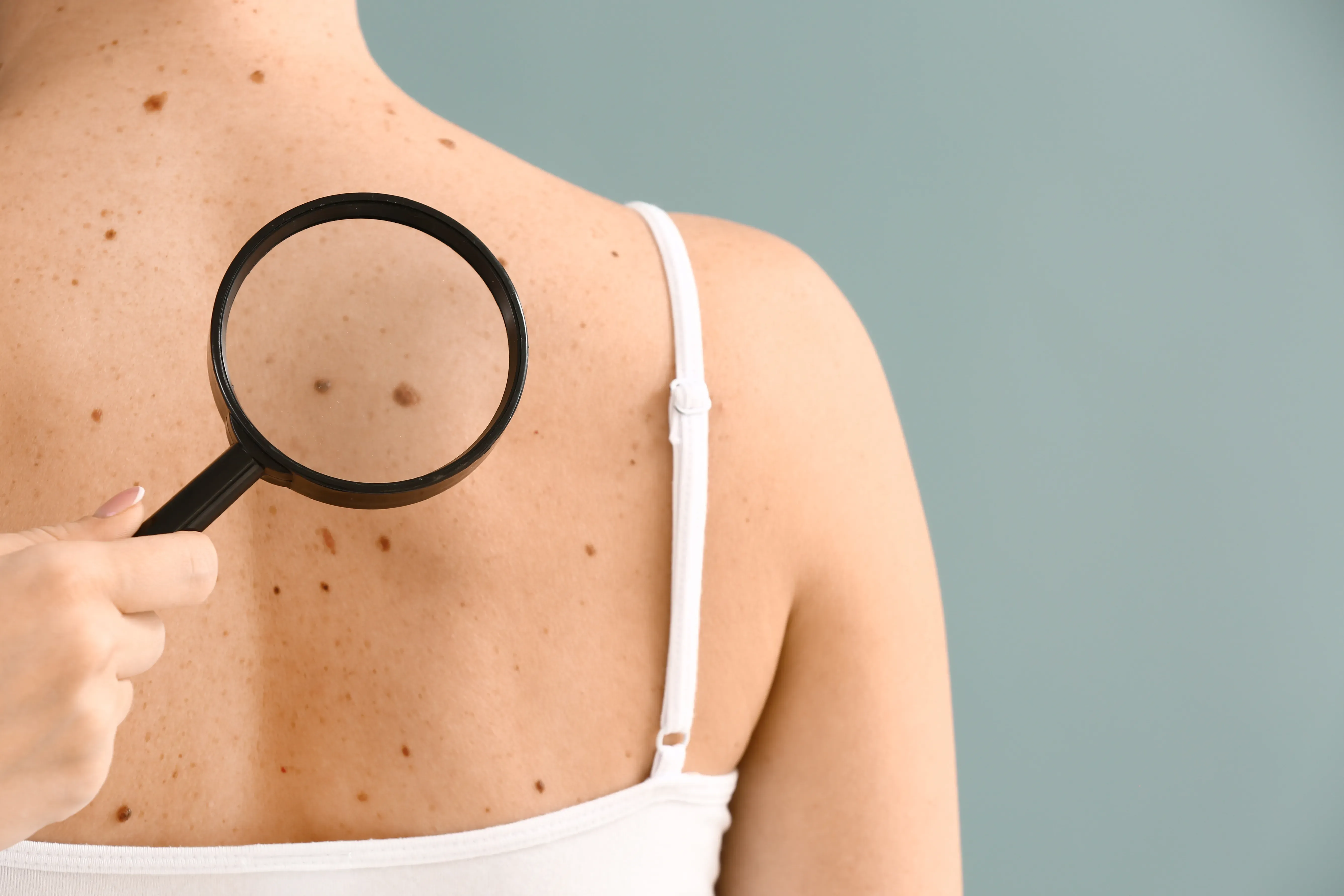 Spotting Abnormal Moles 10 Signs Moles May Be Cancerous Helpme