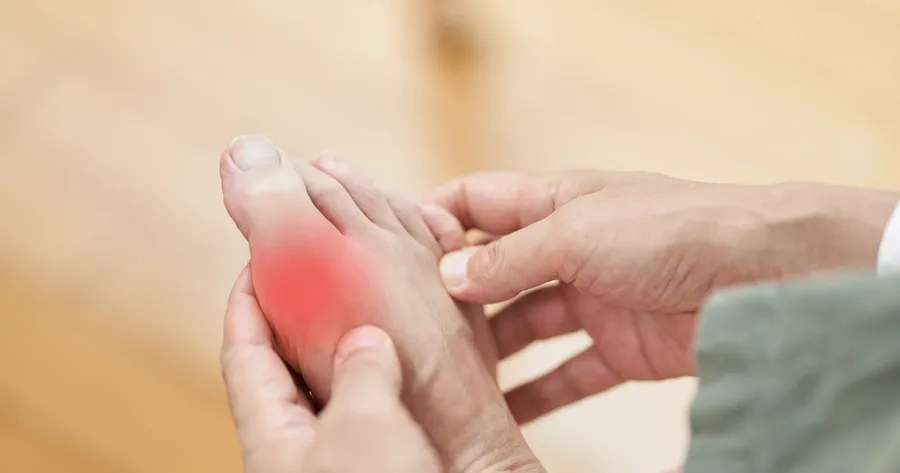 A Guide to Identifying Gout Symptoms
