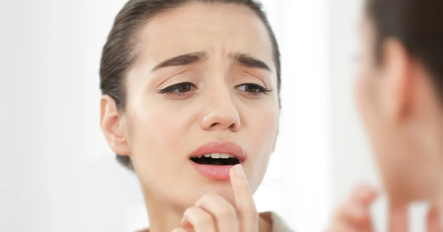 Home Remedies for Canker Sores That Work