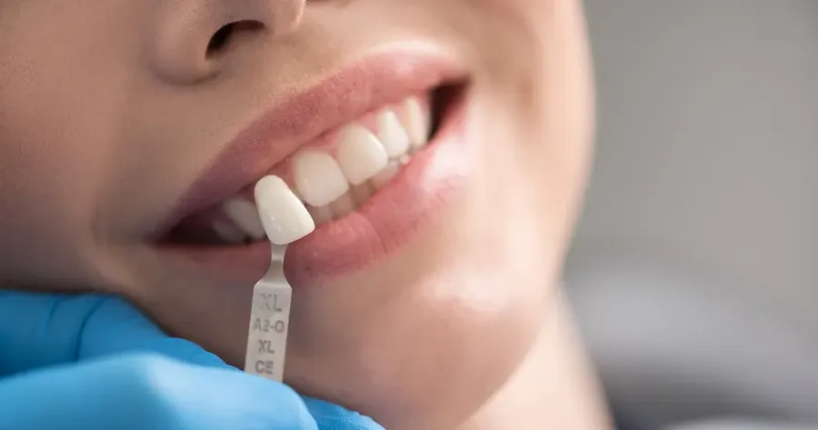 How To Find the Right Tooth Implant Specialist Near Me