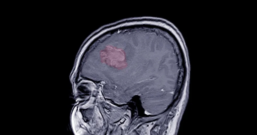 Advancements in Meningioma Treatment Options: What You Need to Know