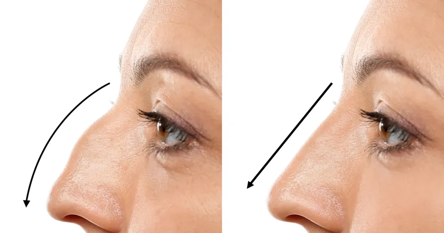 Affordable Rhinoplasty: Quality Nose Surgery Without the Hefty Price