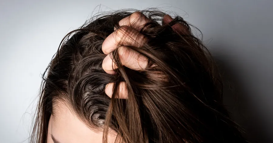 How to Manage Scalp Psoriasis Symptoms Effectively