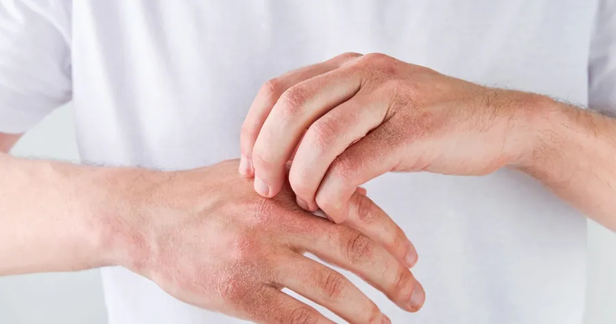 New Approaches in Psoriasis Care