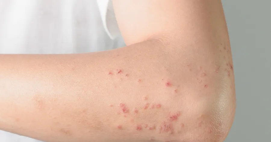 Dermatitis Treatment: Affordable, Effective, and Accessible